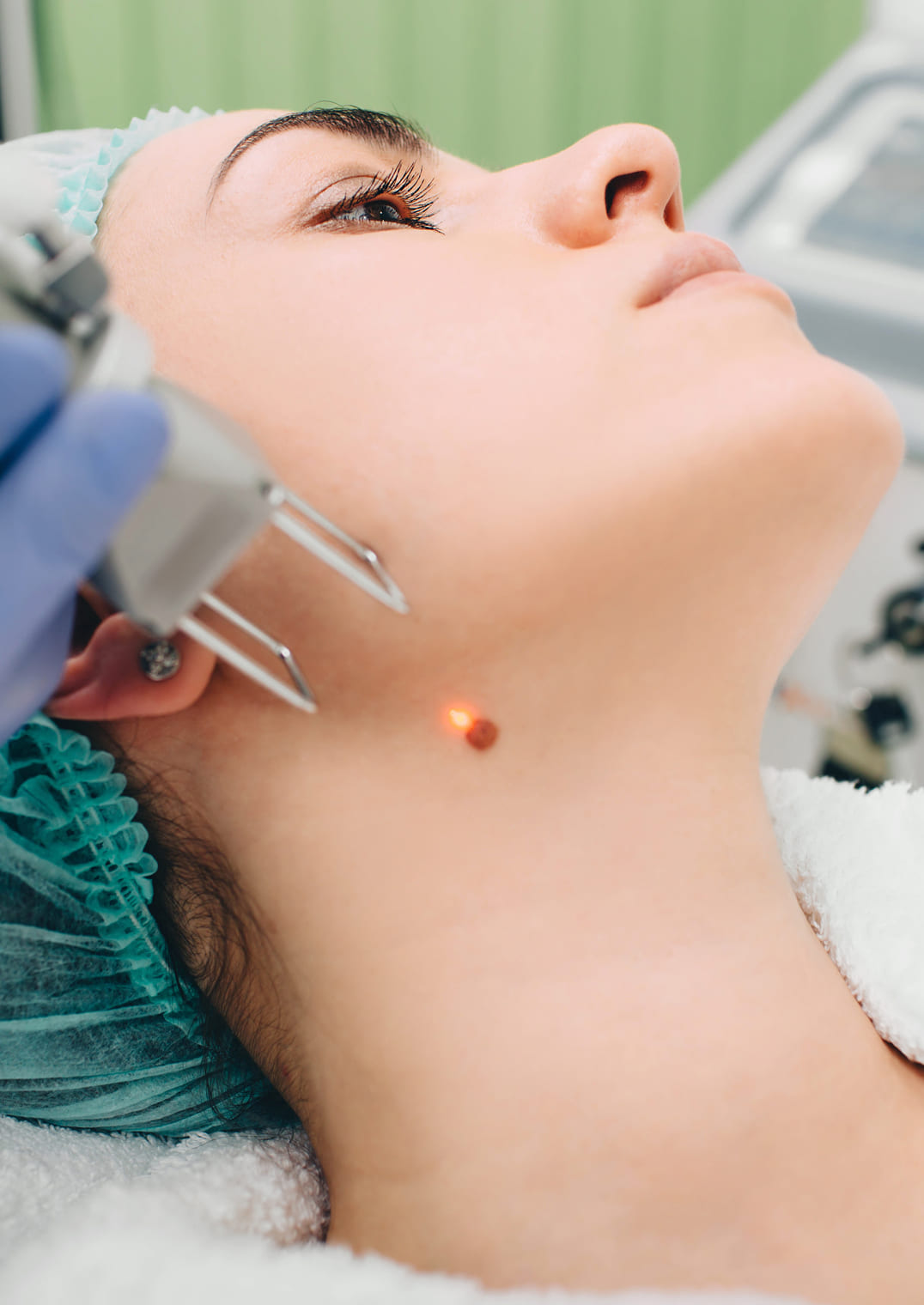 An image of an atypical moles treatment at Coral Dermatology