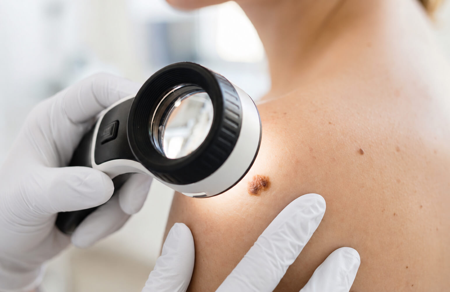 Dermatologist examining a mole with a dermatoscope for skin cancer screening