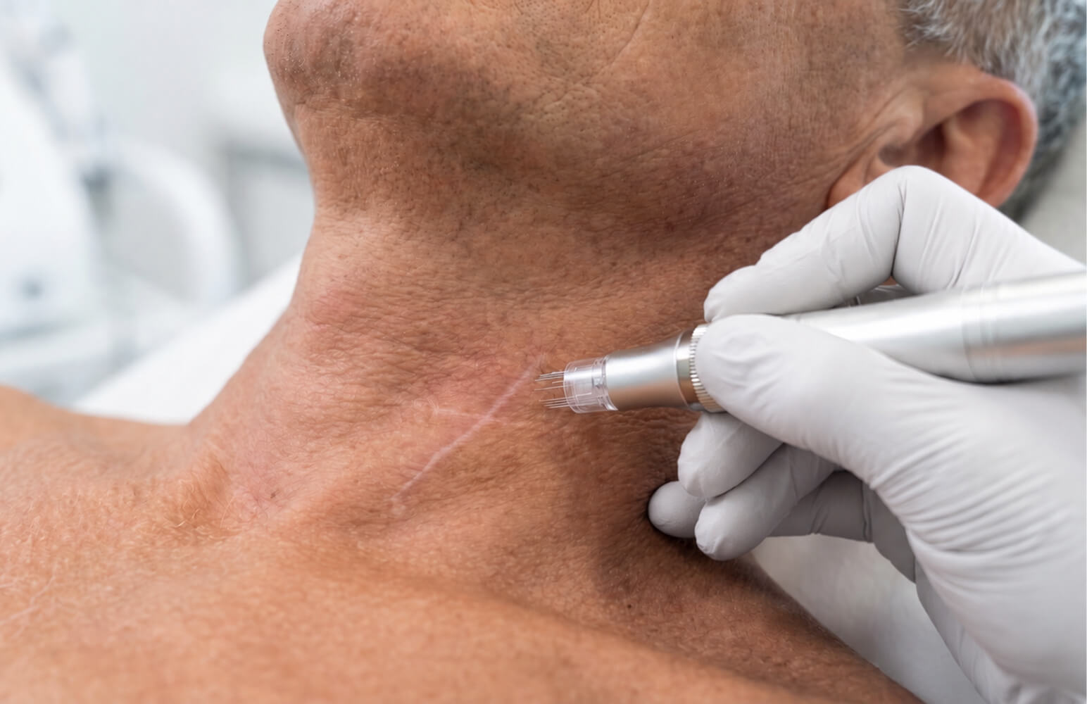 Scar treatment procedure being performed on a patient's neck
