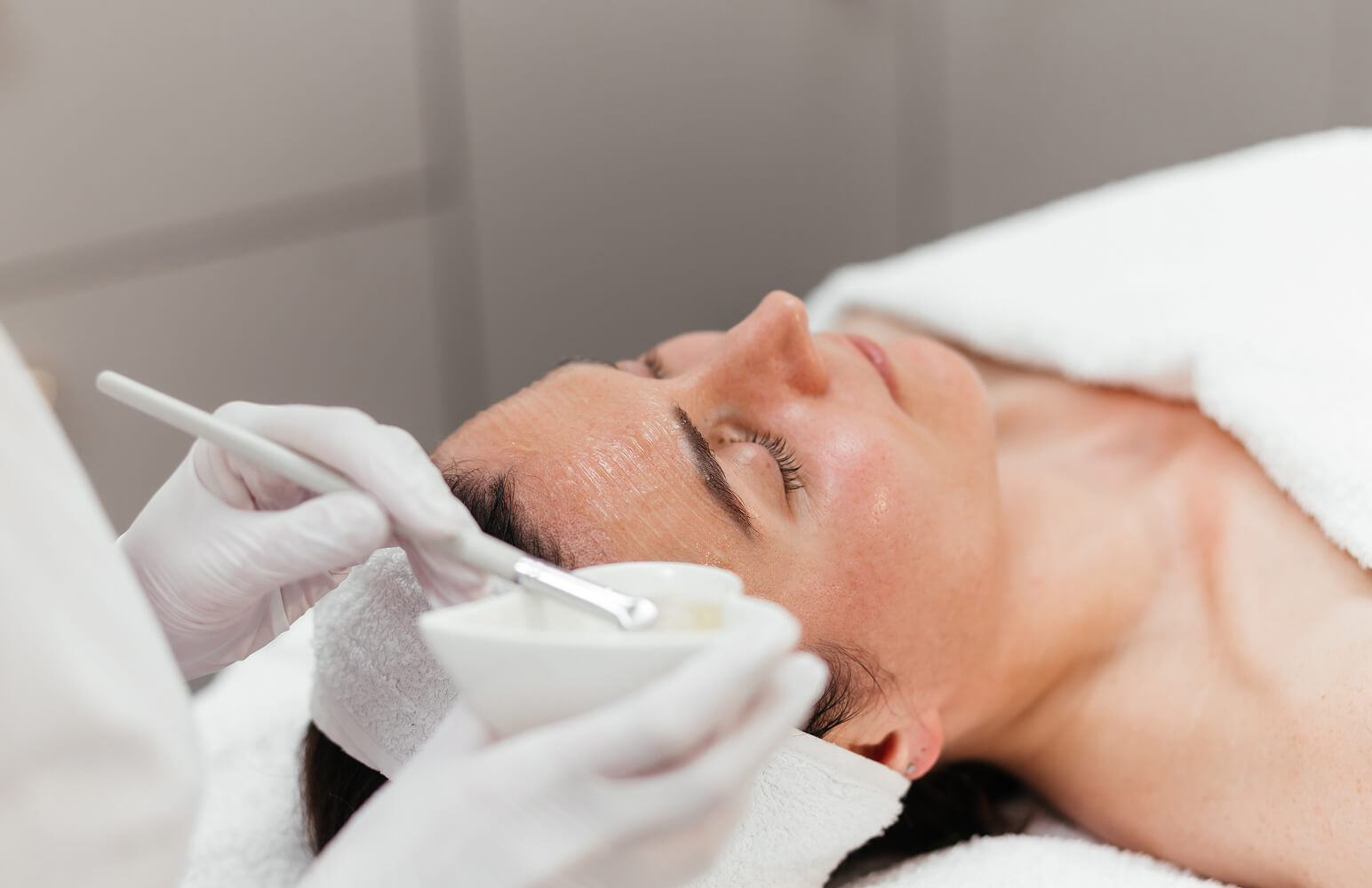 Chemical peel being applied to a patient's face at Coral Dermatology